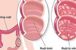 Các chất dinh dưỡng người viêm loét đại tràng hay thiếu hụt và cách bổ sung