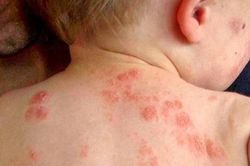 Trẻ sơ sinh có mắc vảy nến không?
