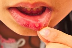 Bị tưa miệng, nhiệt miệng chữa thế nào?