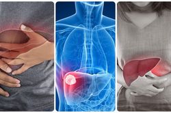 6 dấu hiệu ung thư gan giai đoạn cuối