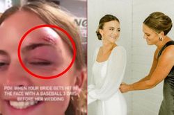 Trước ngày diễn ra hôn lễ, cô dâu bầm tím mắt vì tai nạn không ngờ