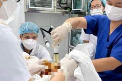 2 lần khâu vòng cổ tử cung, nghẹt thở giữ con cho thai phụ dọa sảy từ 21 tuần