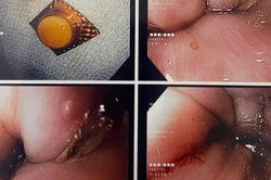 Xử trí đúng khi hóc dị vật đường tiêu hóa