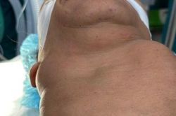 Cứu nữ bệnh nhân nhiều năm bị khối bướu 'bóp cổ'