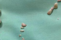 Bác sĩ mổ khối u 'quái' phát hiện 30 chiếc răng bên trong