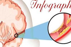 Bác sĩ cảnh báo những thói quen hàng ngày gây thiếu máu não