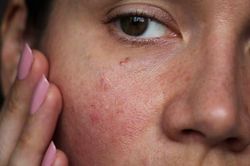 Chăm sóc da nhạy cảm đúng cách