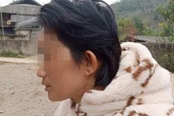 Nối lại toàn bộ da đầu, hai tai, mí mắt bị đứt rời cho nữ công nhân