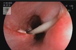 Cô gái bị suýt bị thủng thực quản vì nhờ thầy làm phép