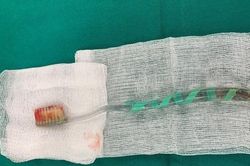 Thiếu niên 16 tuổi nuốt bàn chải đánh răng khi đang ăn thịt gà
