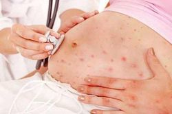 Virus Marburg cực nguy hiểm với phụ nữ mang thai, một số lưu ý để kiểm soát bệnh
