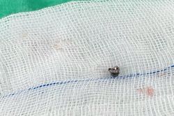 Nghịch súng hơi, bé trai bị đạn chì găm vào xương sọ