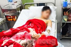 Nam sinh Lào Cai kể phút kinh hoàng bị hai con chó gần 60 kg thả rông cắn