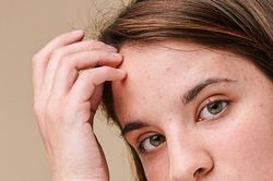 Cách kiểm soát mụn cho da dầu vô cùng hiệu quả