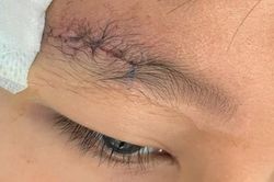 Nghịch súng hơi, bé trai bị viên đạn chì găm sâu vào xương sọ