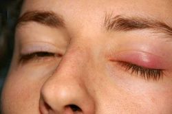 Nhìn vào mắt 5 giây: Nếu thấy dấu hiệu này xuất hiện hãy đi khám xem thận có bị suy yếu không
