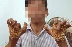 Nhiễm virus HPV có thể bị mắc bệnh hiếm gặp 'người cây' EV?