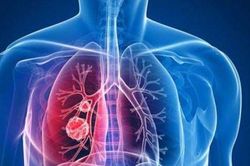 Những ai nên sàng lọc loại ung thư thường gặp nhất?