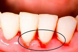 6 triệu chứng bất thường ở răng miệng cảnh báo nhiều vấn đề nguy hại, đặc biệt là cái số 1