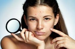 Bí quyết tránh xa mụn trứng cá ngày 'đèn đỏ'