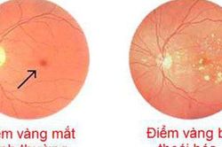 Thuốc mới trị thoái hóa điểm vàng do tuổi tác