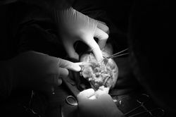 Nam bệnh nhân bị cắt cụt 2 cẳng chân do biến chứng đái tháo đường