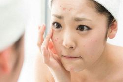 Chăm sóc da mụn đúng cách trong mùa hè