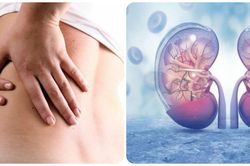 Dấu hiệu ung thư thận giai đoạn đầu