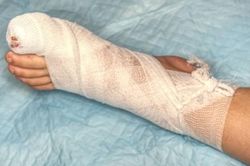 Lạm dụng kháng sinh, người đàn ông suýt cụt chi