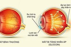 Ứng dụng thành công AI vào tầm soát bệnh lý thần kinh thị giác