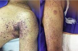 Bộ Y tế: Chỉ đạo phòng, chống lây nhiễm bệnh liên cầu lợn sang người