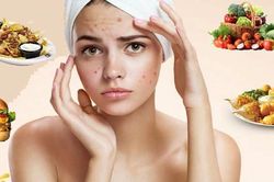 Người bị mụn không nên ăn gì?