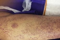 Dấu hiệu bạn đã mắc bệnh liên cầu lợn