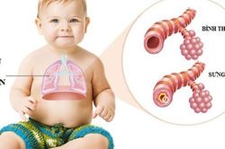 Chữa viêm tiểu phế quản ở trẻ như thế nào?