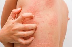 Lý do nổi mẩn, ngứa khó chịu sau mỗi lần thể dục, ăn cay nóng