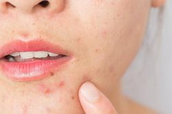 Cách dùng mật ong trị mụn
