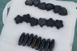 Bé trai nuốt 20 viên nam châm phải cắt bỏ 1 đoạn ruột