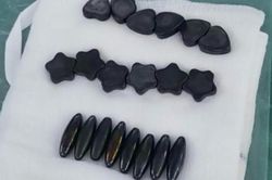 Bé trai phải cắt bỏ 15 cm ruột non do nuốt phải nam châm
