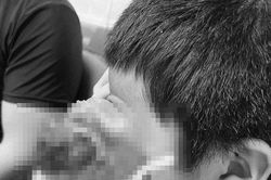 Xót xa bé trai 4 tuổi bị 'u quái khổng lồ' tại hốc mắt che gần hết mặt