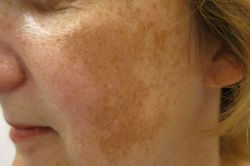 Tại sao khoai tây làm mờ được vết nám?
