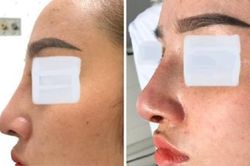 Cô gái 26 tuổi bị áp xe sau khi phẫu thuật nâng mũi