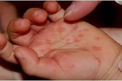 Phòng, tránh bệnh tay chân miệng ở trẻ