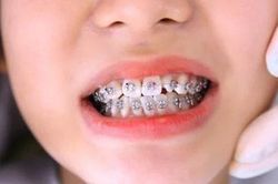 Bác sĩ tiết lộ sự thật về lời đồn 'cứ niềng răng là bị hóp má' và nguyên tắc cần nhớ để khắc phục