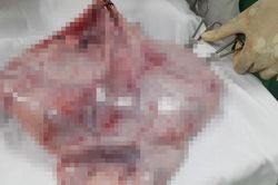 Cô gái 19 tuổi mang khối u buồng trứng 8,5kg
