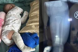 Malaysia: Phát hiện con bị gãy chân sau 2 tuần gửi người trông trẻ