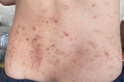 Hà Tĩnh: Nhiều người bị côn trùng 'lạ' đốt gây sẩn ngứa