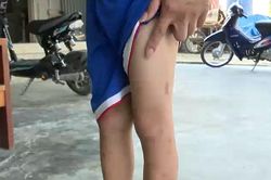 Bọ chét cắn gây mẩn ngứa lây lan diện rộng ở Hà Tĩnh