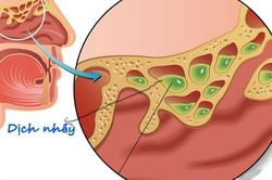 6 biện pháp tự nhiên điều trị nghẹt mũi