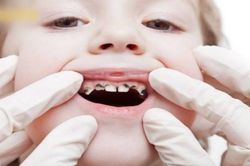 Bé 3 tuổi sâu cả hàm răng vì thói quen tưởng tốt này