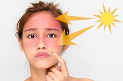 Điều bạn tuyệt đối không nên làm khi da bị cháy nắng